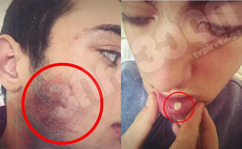 20 წლის ახალგაზრდა პოლიციას სასტიკ ძალადობაში ადანაშაულებს.  ლუკა თოფჩიშვილი ირწმუნება, რომ გორში მასზე 15-მდე სამართალდამცველმა ჯერ ქუჩაში იძალადა, შემდეგ კი ფიზიკურად პოლიციის განყოფილებაში გაუსწორდა. ნაცემი ახალგაზრდა ამ დრომდე კლინიკაში რჩება, მას ტვინის შერყევა აქვს და თავის არეში დაზიანები ამ დრომდე აღენიშნება.